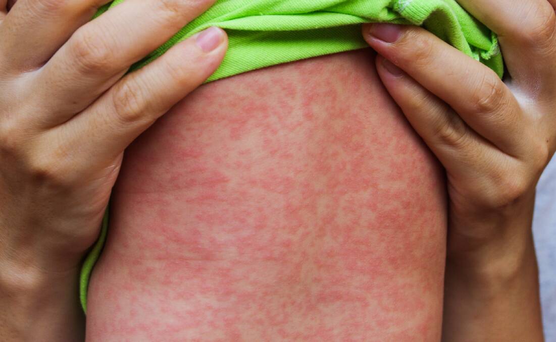 Four separate measles cases now confirmed in our area